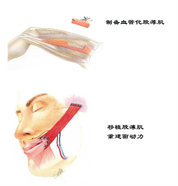 的口角运动功能 在显微镜下将闭孔神经与咬肌神经或跨面神经移植物吻