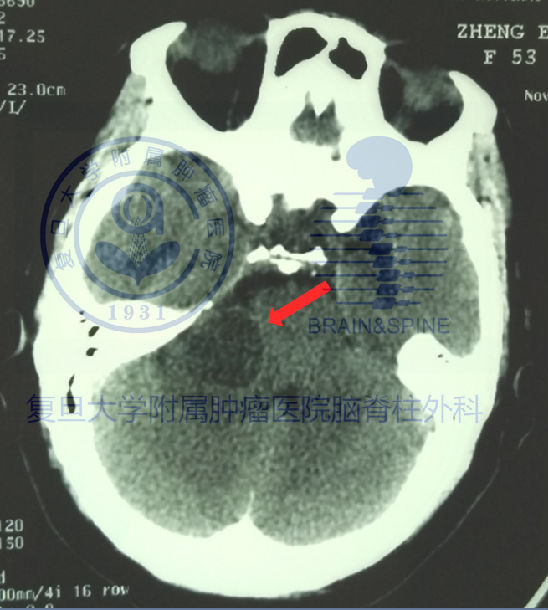 ct显示的肿瘤骨窗位显示扩大的内听道mri:角增强mri为诊断昕神经瘤的