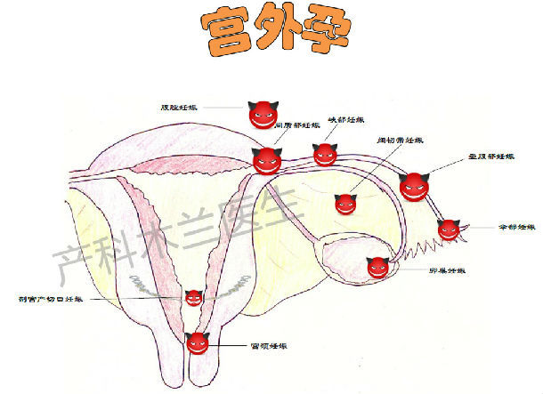 宫外孕图示