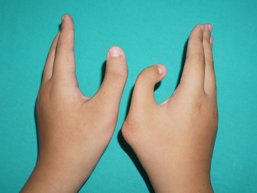 儿童拇手指畸形矫正应该重视截骨的细节-典型病例