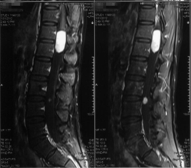 患者为男性37岁,因腰部 疼痛 伴左侧下肢无力1年入院,外院腰椎磁共振