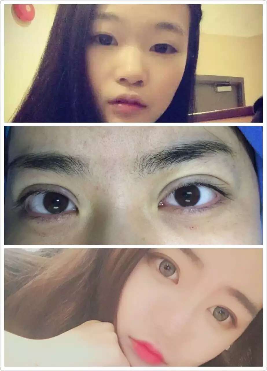 微创翘睫双眼皮术前,术后,术后一月