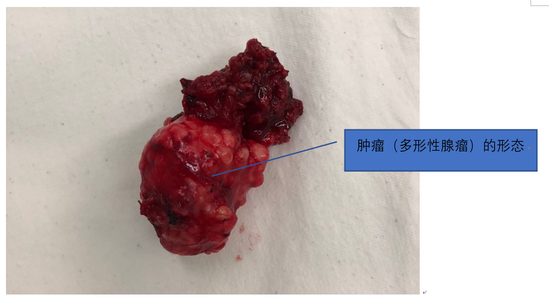 个性化手术切口在治疗复杂腮腺肿瘤中的应用