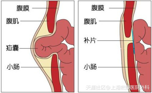 你了解疝气吗