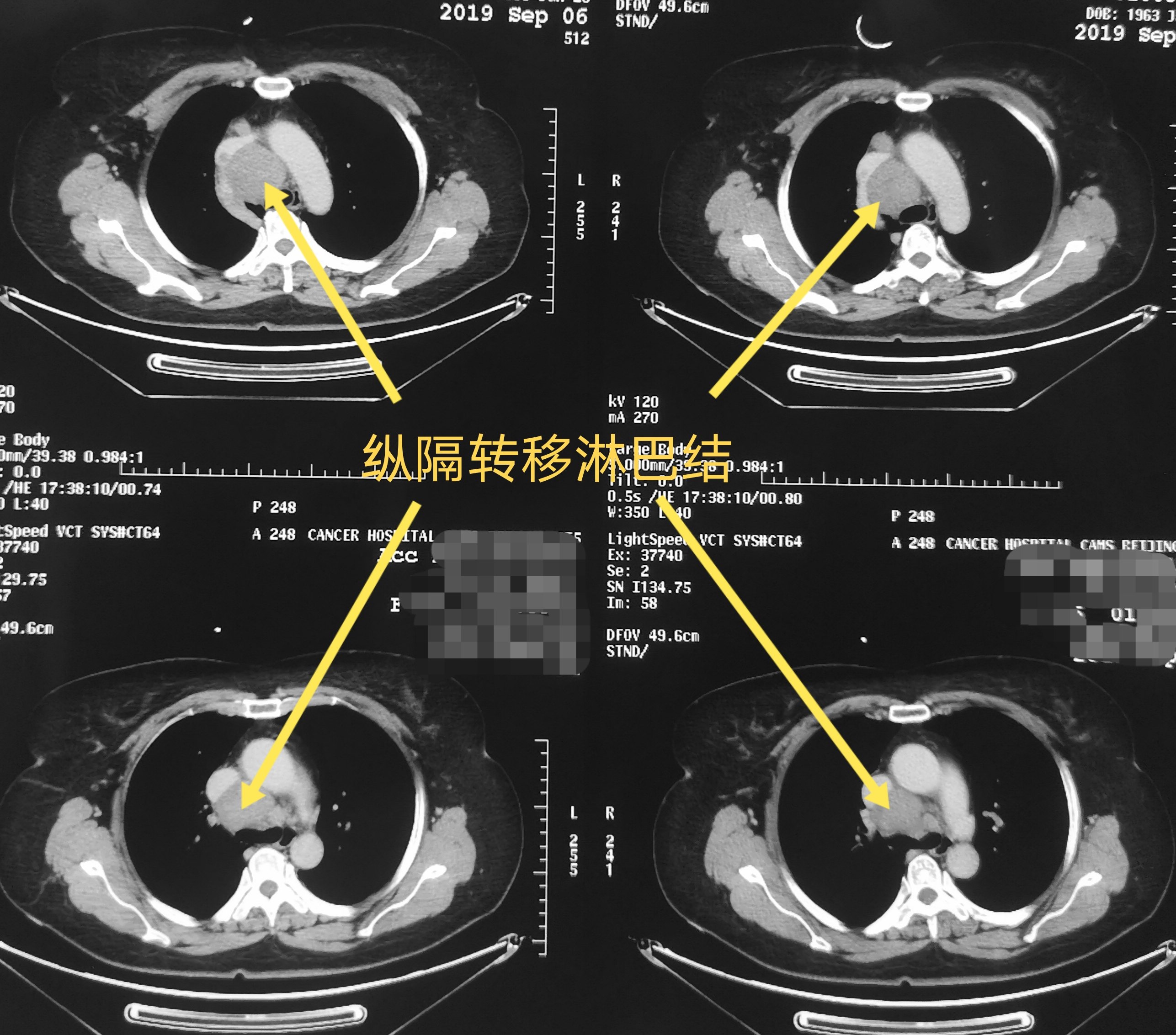 甲状腺癌外院术后颈部及纵隔淋巴结转移侵及右无名静脉上腔静脉瘤栓