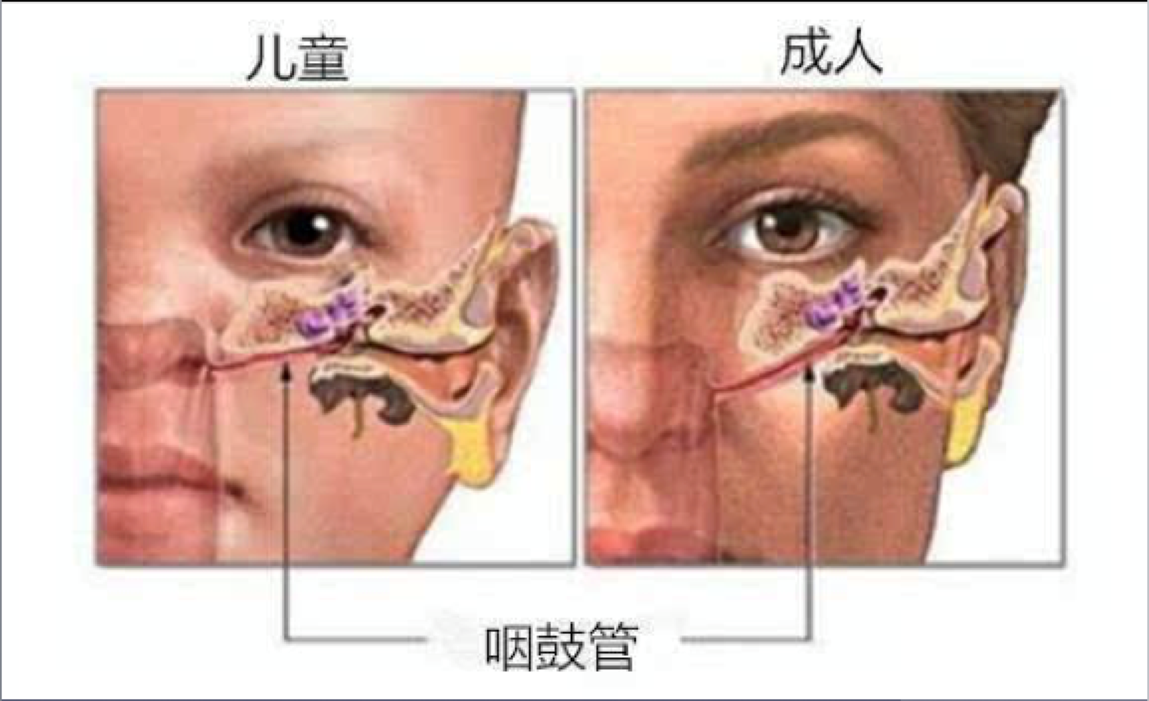 科普腭裂与分泌性中耳炎