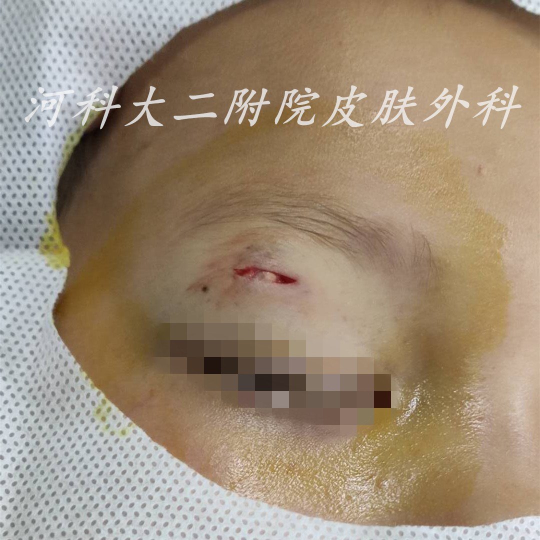 白话-表皮囊肿