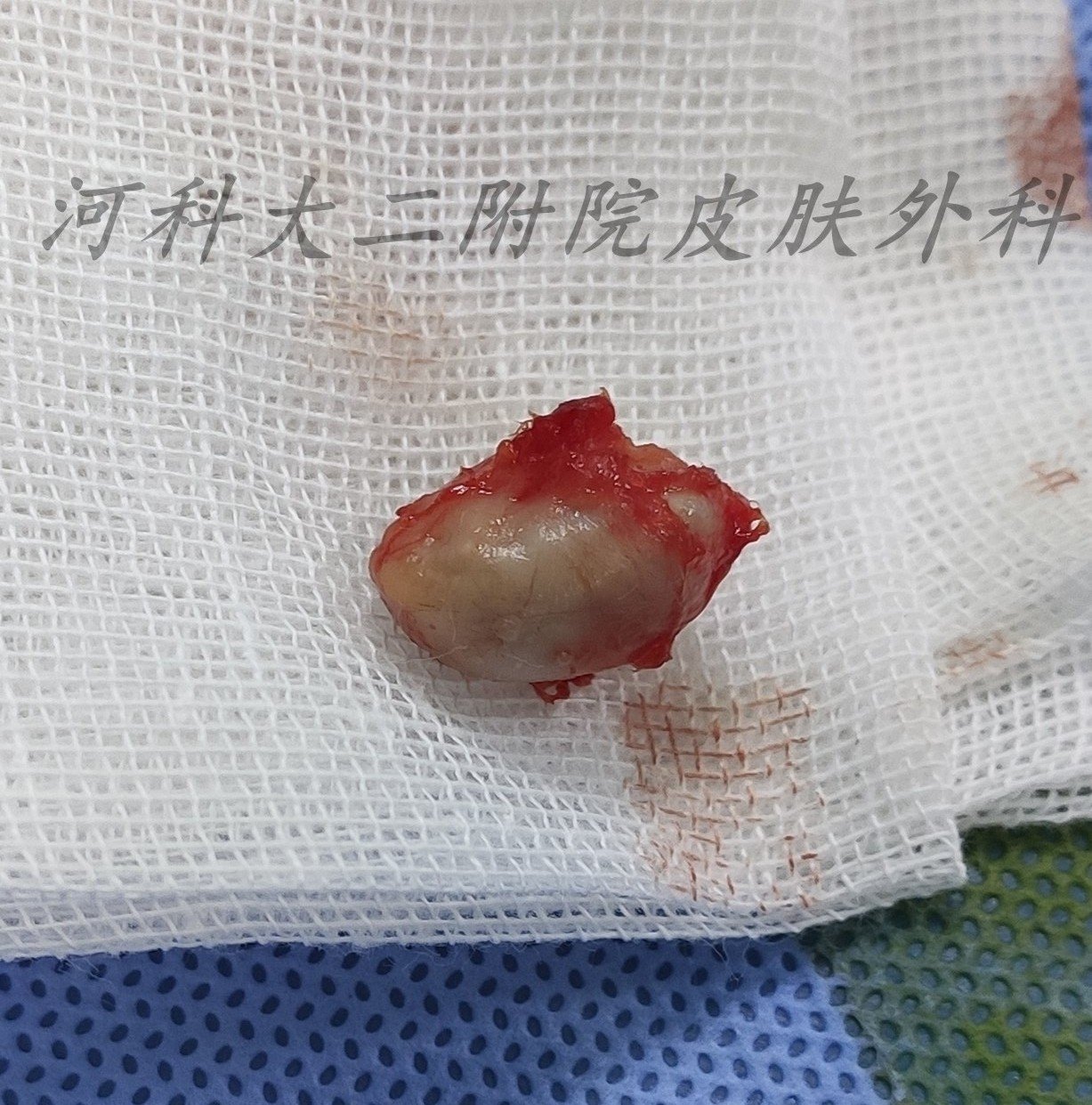 表皮囊肿看起来是什么样子的?