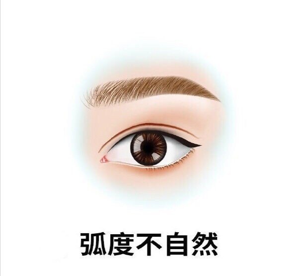 双眼皮失败的八种图片