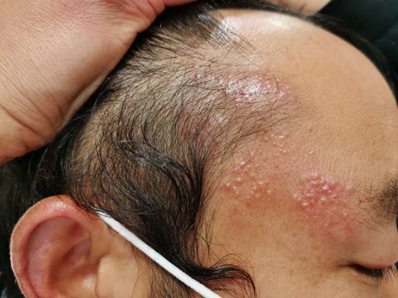 眼睑带状疱疹及引起的病毒性角膜炎的经验治疗