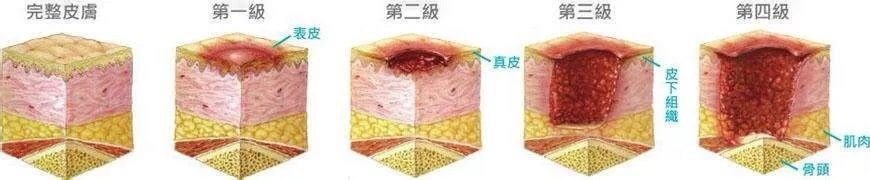 褥疮的窦道形成的原因是什么该如何治疗好