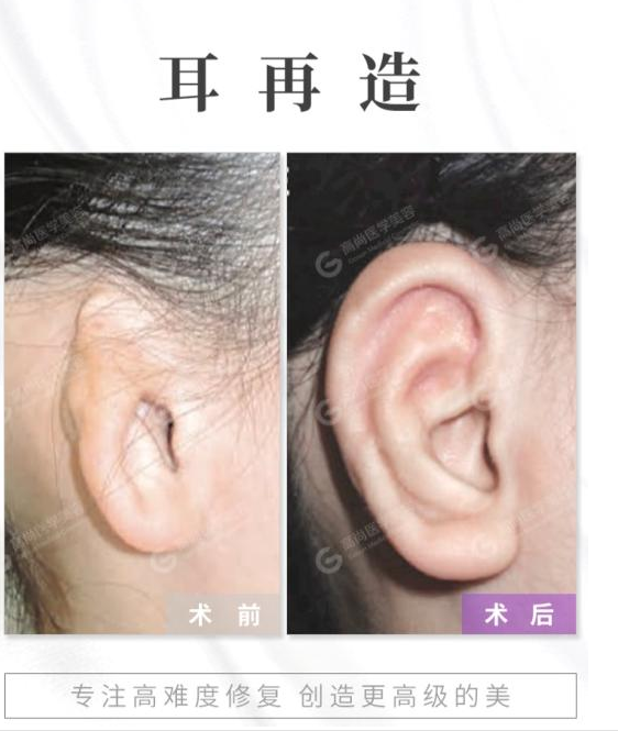 先天性耳朵畸形图片出现小耳畸形可通过耳再造手术治疗