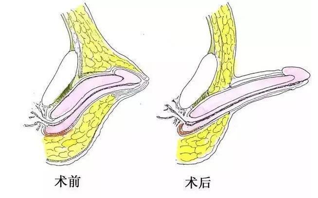 隐匿型阴茎和包茎两者有什么区别呢?