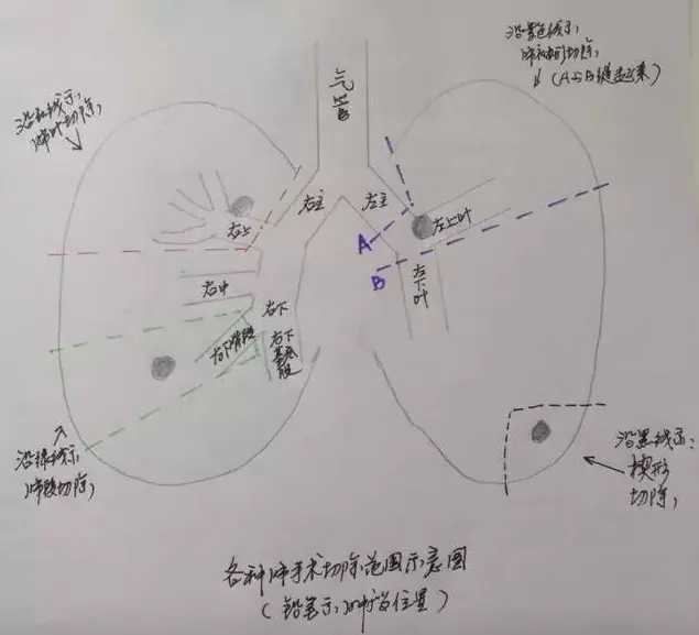 早期肺癌肺部磨玻璃结节胸部ct影像与手术处理及预后