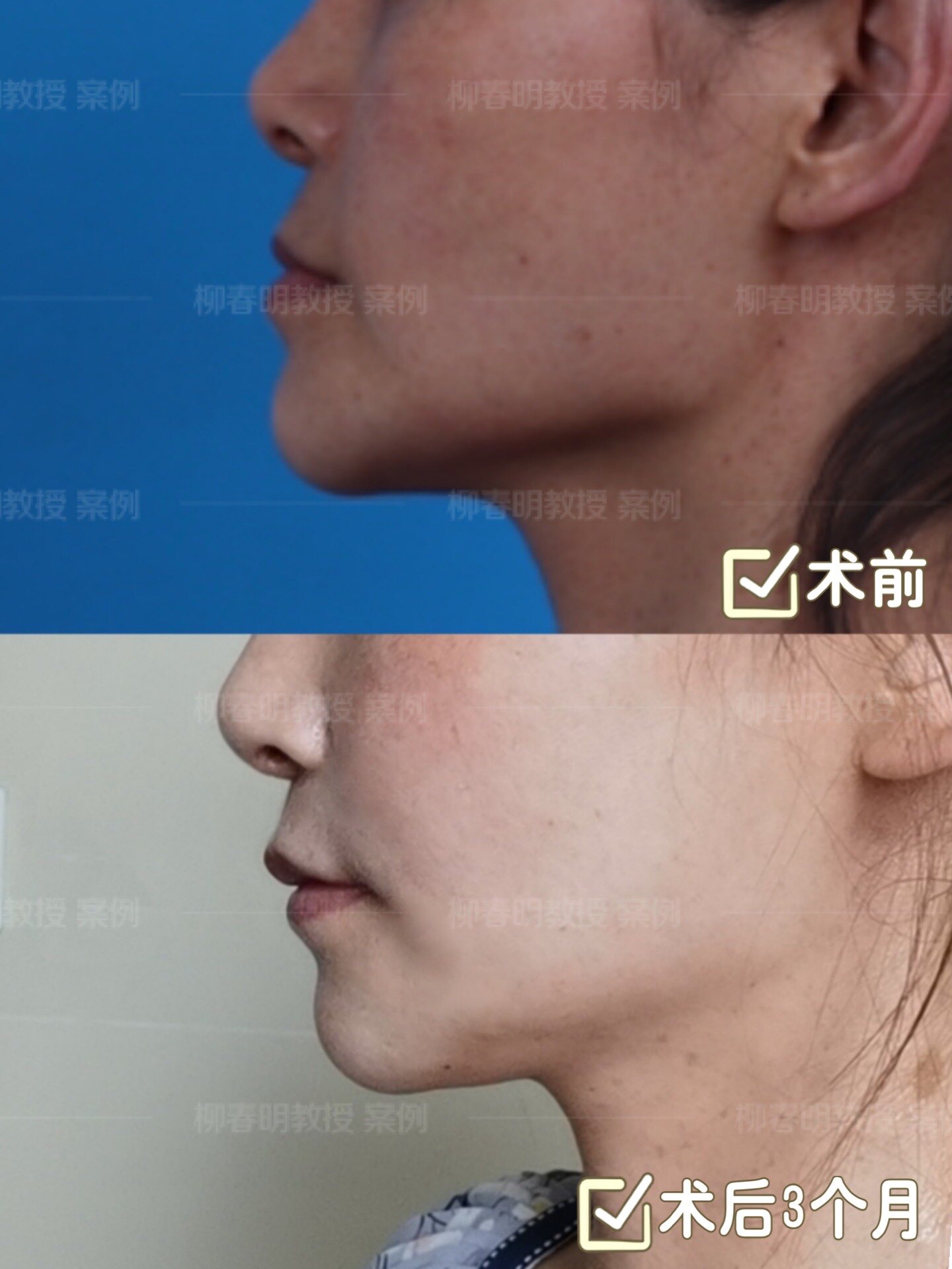 正颌手术地包天矫正术术式下颌矢状劈开术后3个月反馈照片为案例我院