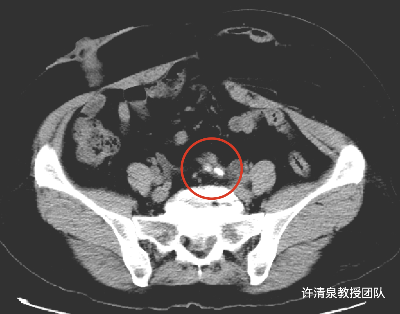 的容器,将输尿管接到肠管上,再将肠管连接到尿道或在腹壁开个洞挂袋