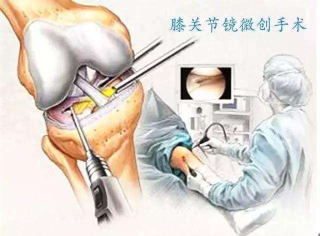 (2)人工关节置换手术(包括单髁置换术,髌股关节置换术,全膝表面置换术
