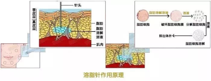 溶脂针其原理是通过使用有助于脂肪代谢的成分所搭配而成的药品注射到