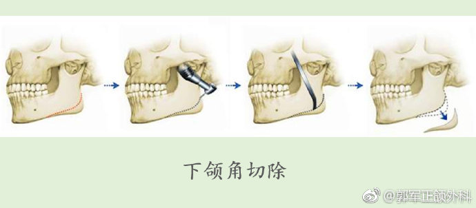 下颌角术后骨增生的问题,关注的人很多,我就我从医多年的经历来大致