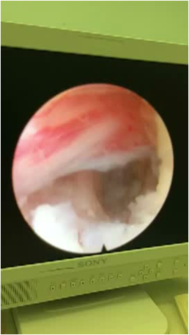 腰椎间盘突出症的治疗方法