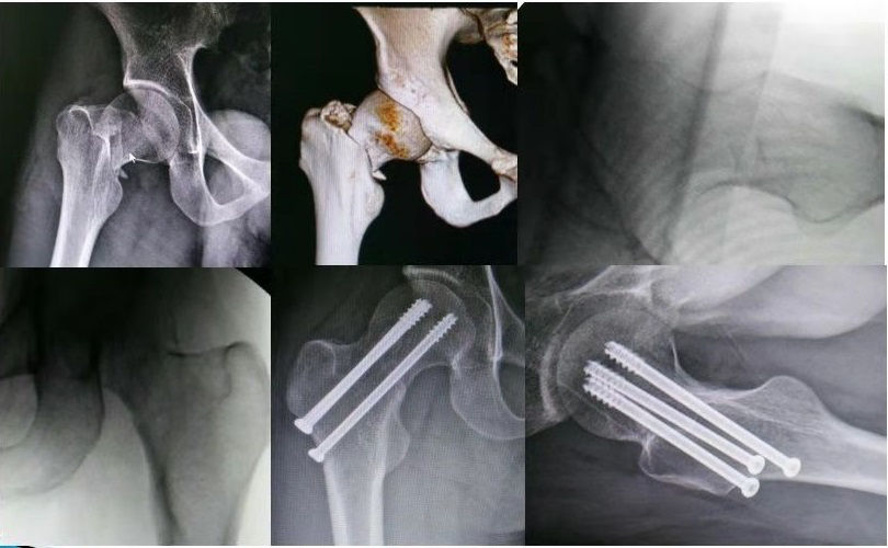 杨良锁 > 人生最后一次骨折:股骨颈骨折股骨颈 骨折 如何治疗?