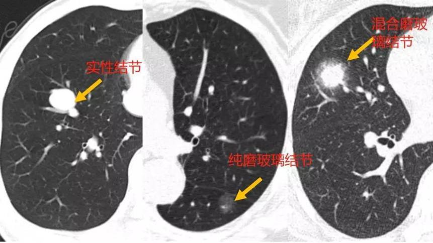 肺结节的真相