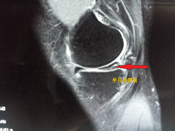 半月板手术后遗症
