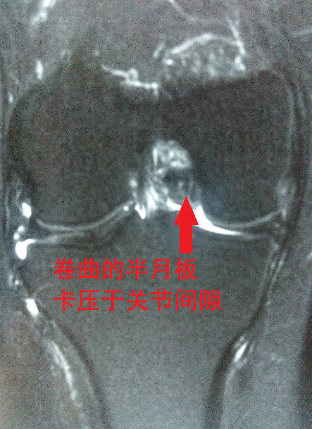 膝关节半月板损伤的关节镜微创手术