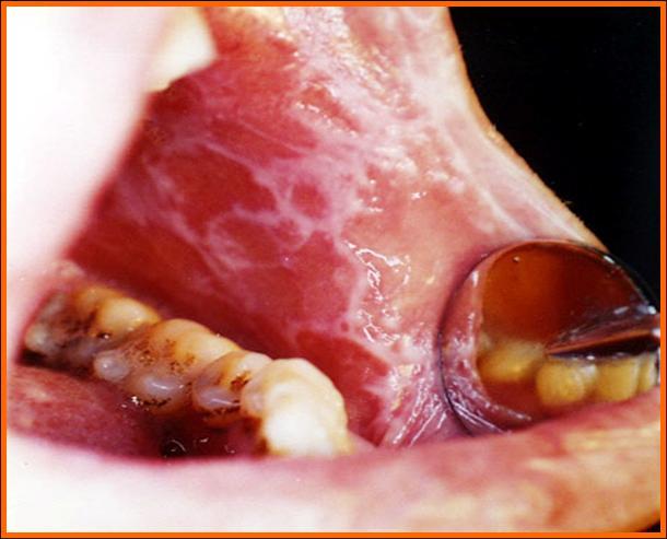 口腔扁平苔藓是什么病?会不会癌变?