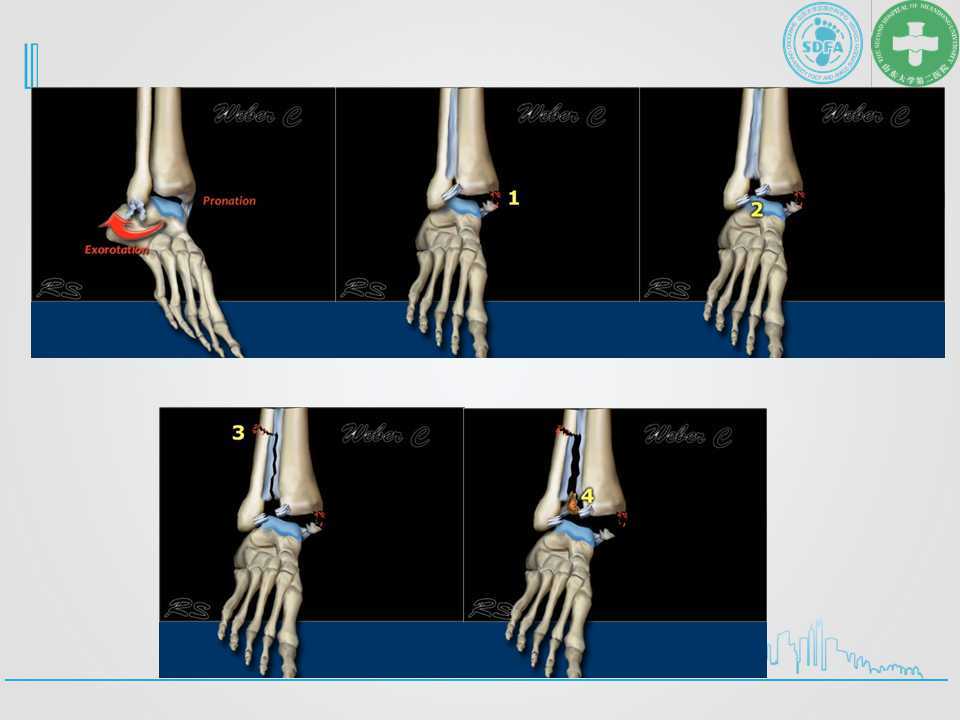 踝关节骨折的分型