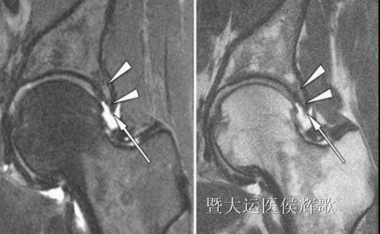 1,髋关节磁共振(注意是单侧,有斜矢状位,斜冠状位,360°放射状的薄层