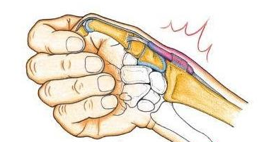 桡骨茎突狭窄性腱鞘炎的表现特征是腕关节桡侧疼痛,并与拇指活动有