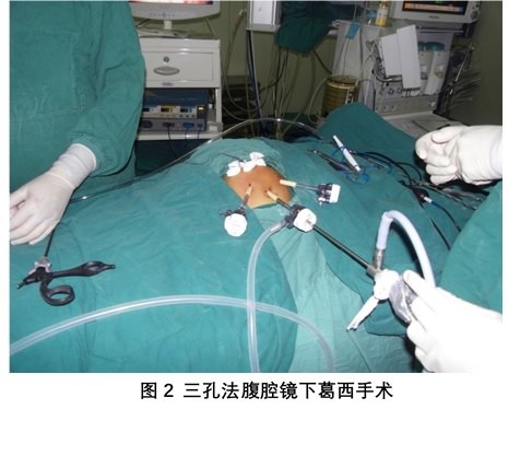 腹腔镜下葛西手术是近年来发展起来的微创技术.