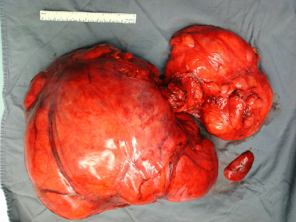 巨大肿瘤似孕妇,妙手回春病痛除----腹膜后巨大脂肪肉瘤 (转载)