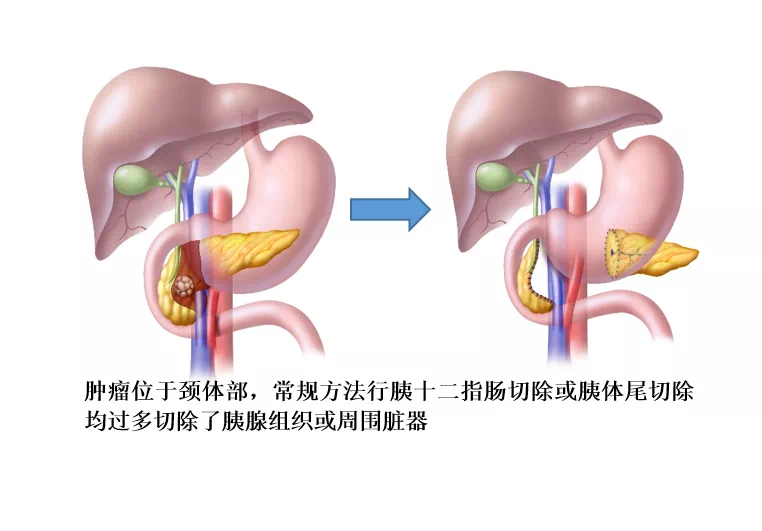 保留功能的胰腺节段切除术包括胰腺中段切除,保留十二指肠胰头切除术