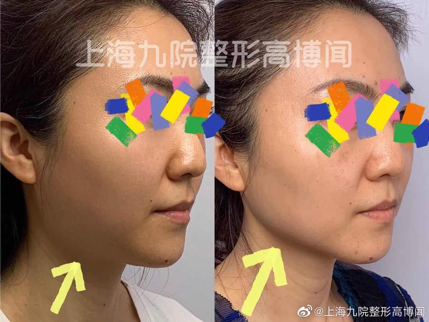 下图为热玛吉五代 肉毒素下颌缘提升一个月对比,较治疗前相比法令纹变