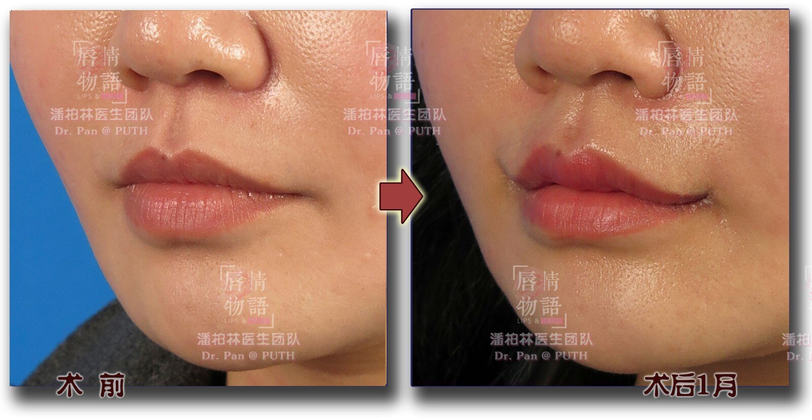 上唇综合整形(upper lip vermilion plasty:修薄/m唇/Ω唇