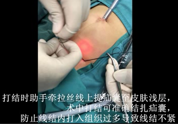 巨大疝气/鞘膜积液或者较大年龄/肥胖儿童行腹腔镜微创手术需注意的几