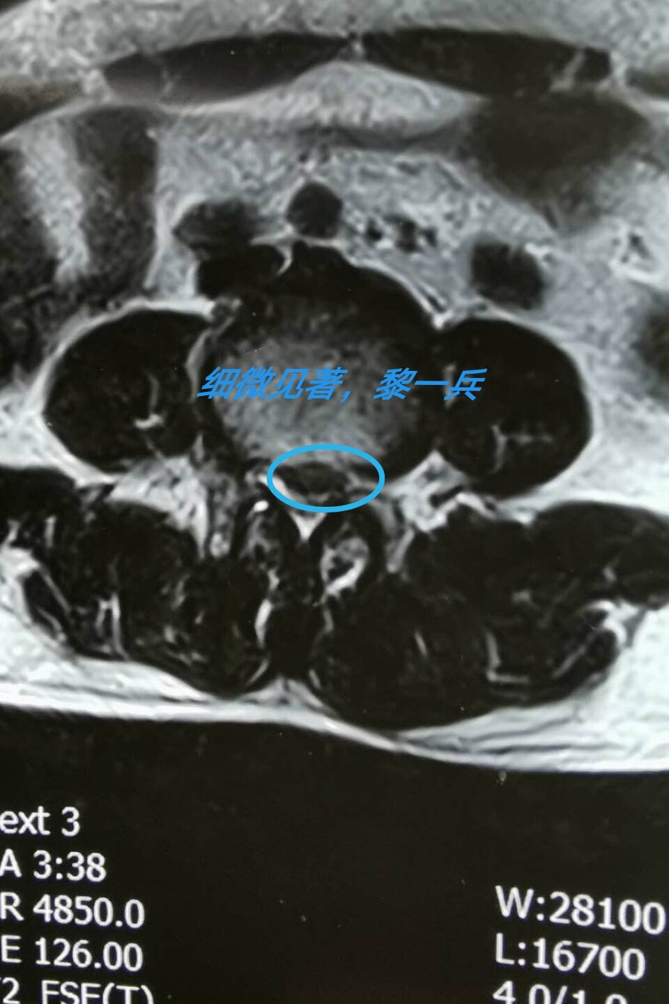 腰椎间盘突出合并椎管狭窄微创治疗病例分享