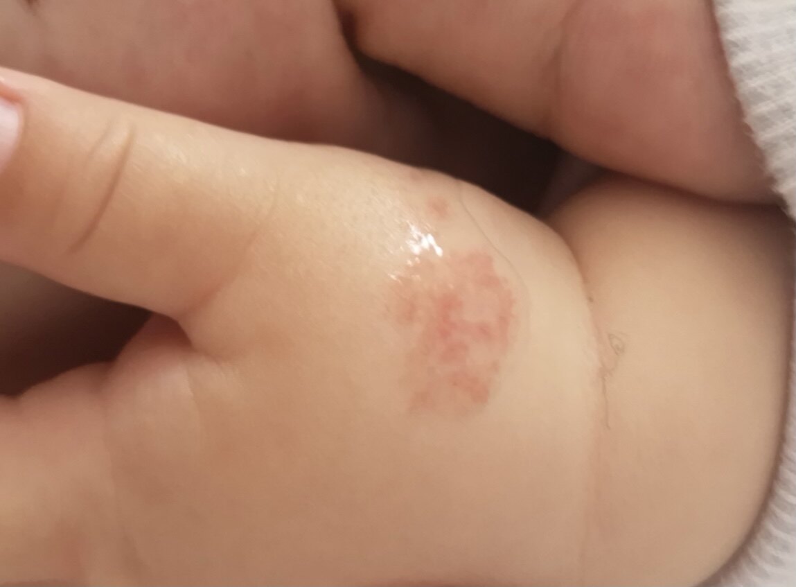 大部分血管瘤发病于皮肤,皮下组织等相对表浅的部位,一般在婴儿出生1