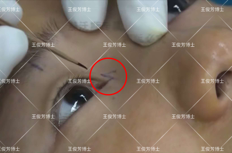 1, "z"瓣成形法:方法以赘皮为纵轴,设计"z"形瓣,切开两对偶三角瓣.