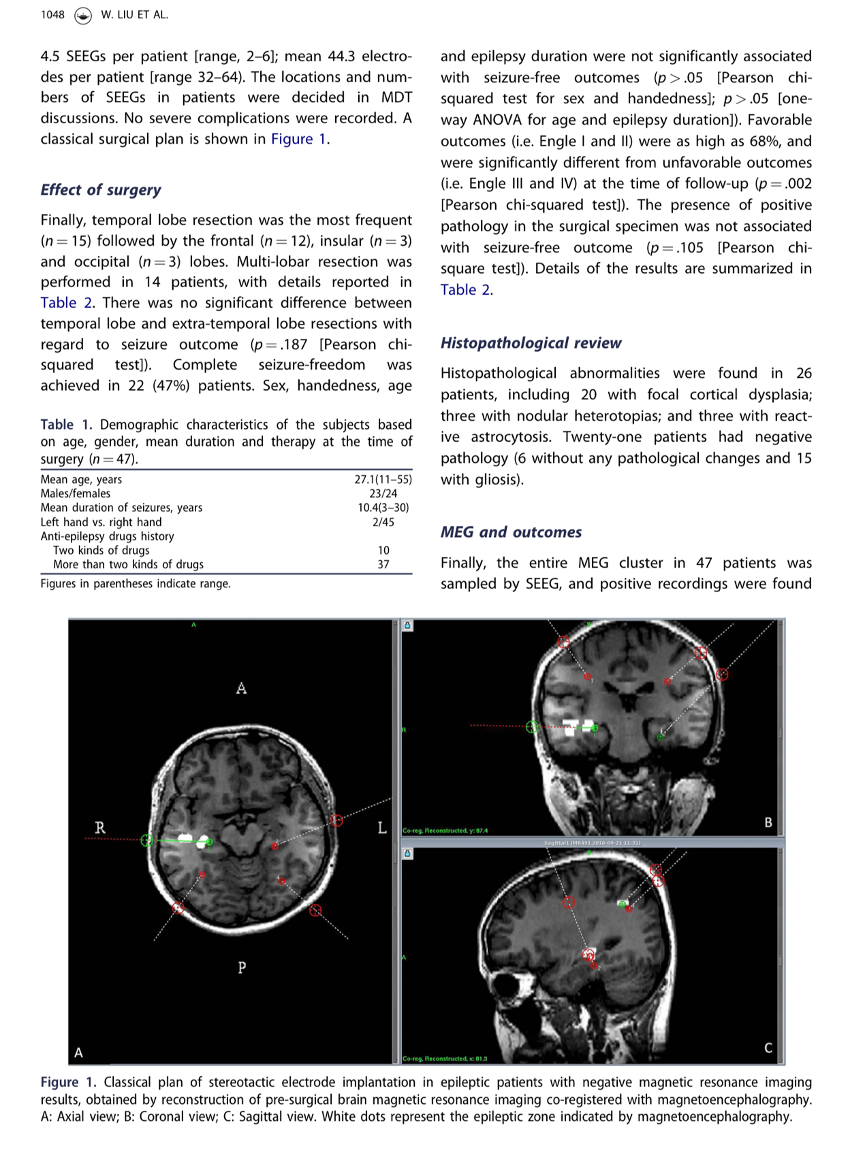脑磁图(meg)引导的立体脑电图(seeg)在核磁共振成像(mri)阴性的癫痫