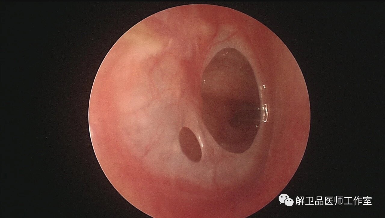 图1:中耳炎鼓膜穿孔在门诊常有很多病人会问:医生,耳朵发炎是小毛病