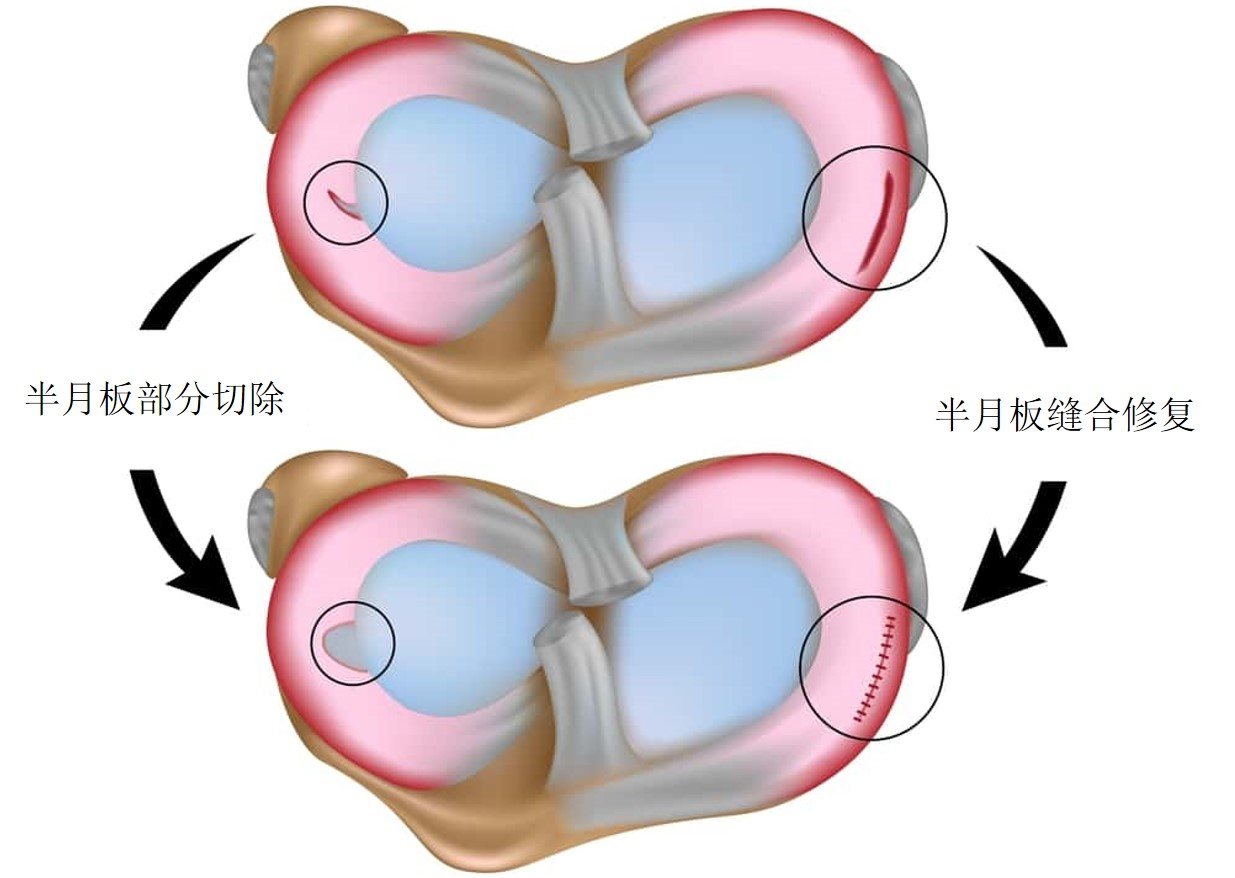 一般适合作半月板部分切除术(图28)