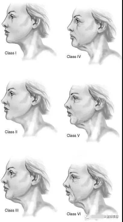 刀锋论坛颏颈部脖子颈部衰老严重程度分级和治疗原则