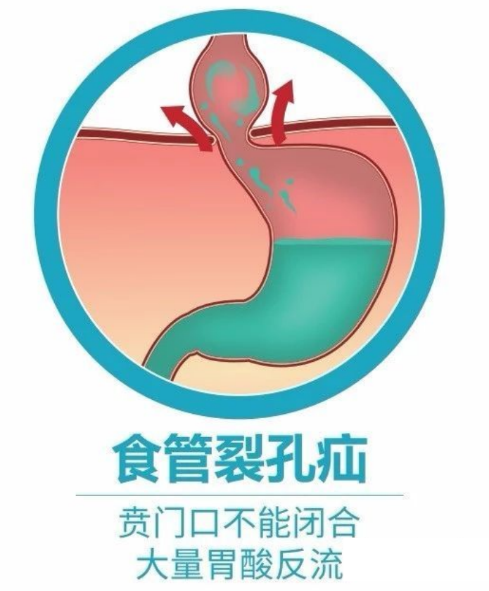 食管裂孔疝是什么病应该如何治疗医生详解治疗方案