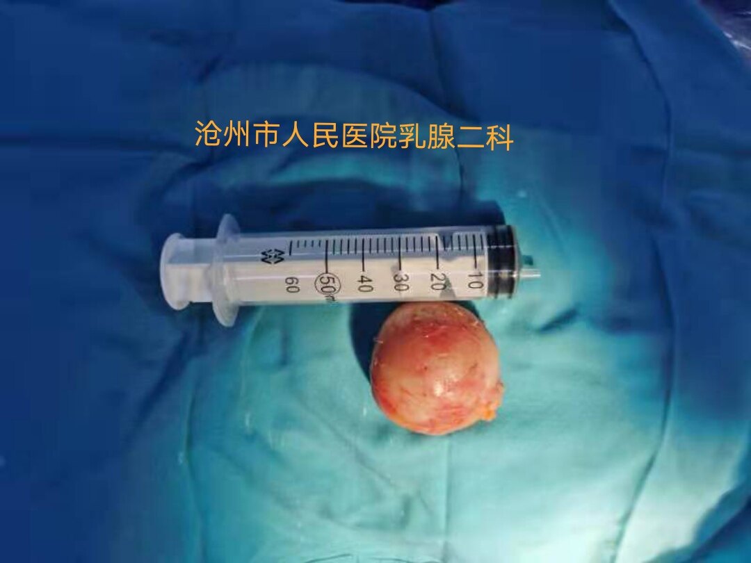 腔镜下乳腺巨大肿物切除术