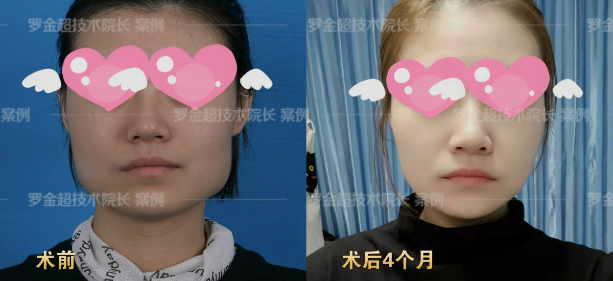 如果是脂肪因素,建议通过面部吸脂术或是填充术改善;如果是骨