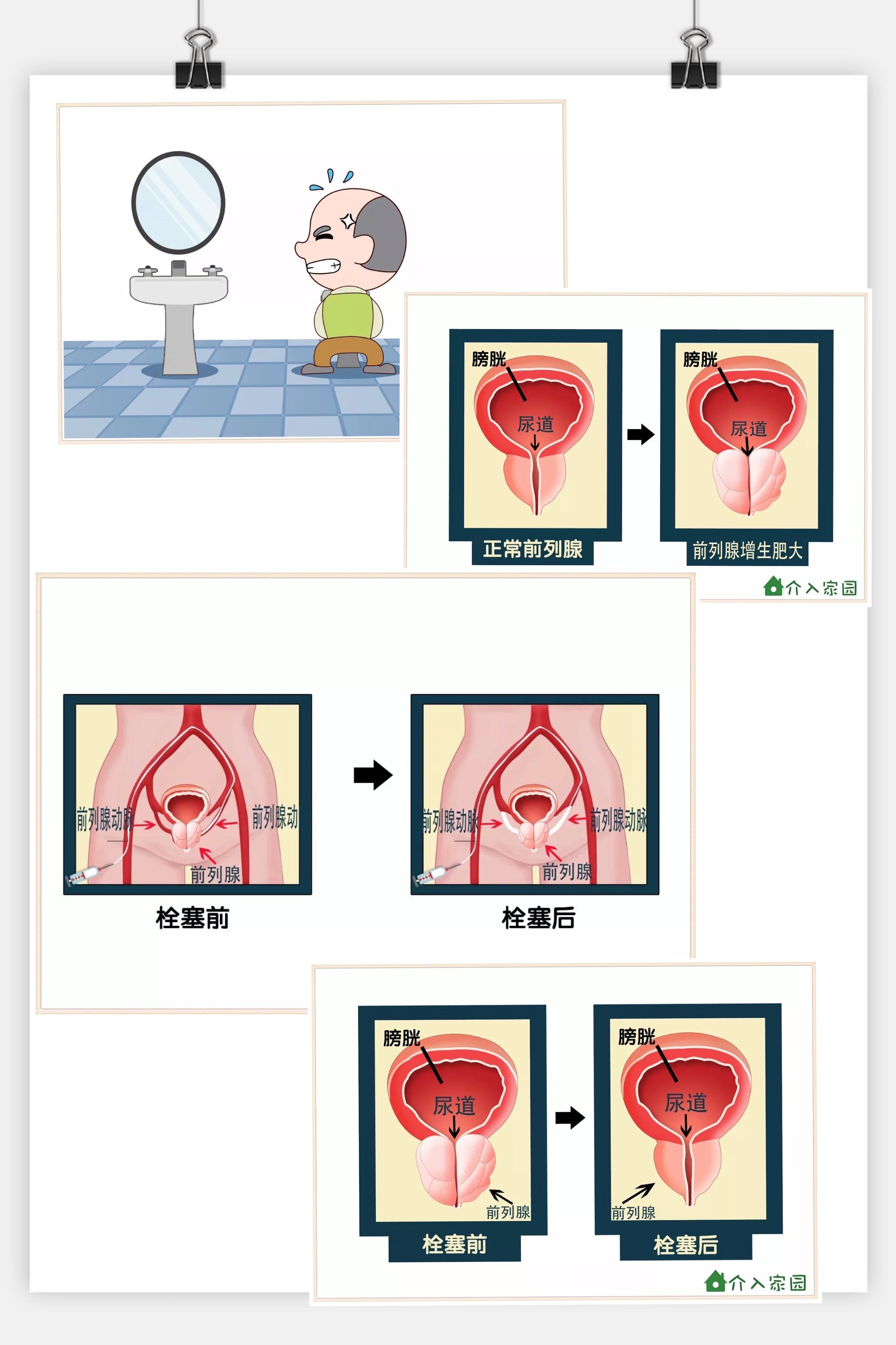 前列腺增生除了开刀还有别的办法吗?当然,介入治疗帮您解决