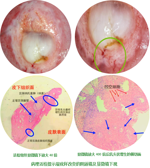 但提示是有hpv感染,由于这个hpv病毒是发生宫颈癌或者尖锐湿疣的病因